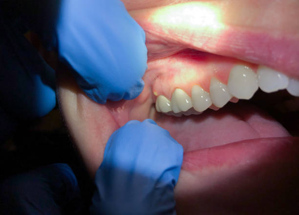 Best Broken or Cracked Tooth Emergency Dentist in Accokeek, MD